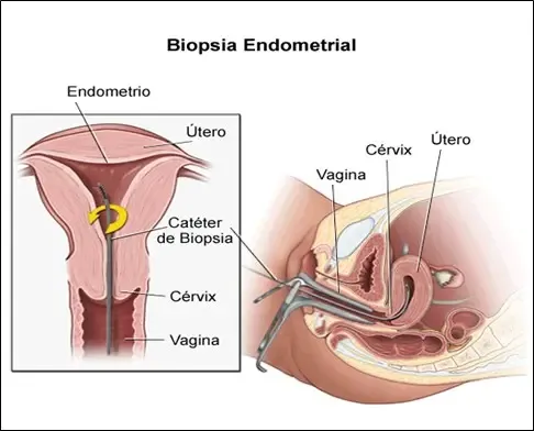 Como é a biópsia de endométrio