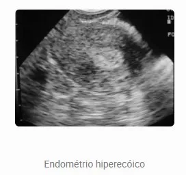 Aspecto endometrial ao ultrassom — Hiperecóico