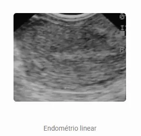Aspecto endometrial ao ultrassom — Linear