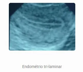 Aspecto endometrial ao ultrassom — Trilaminar